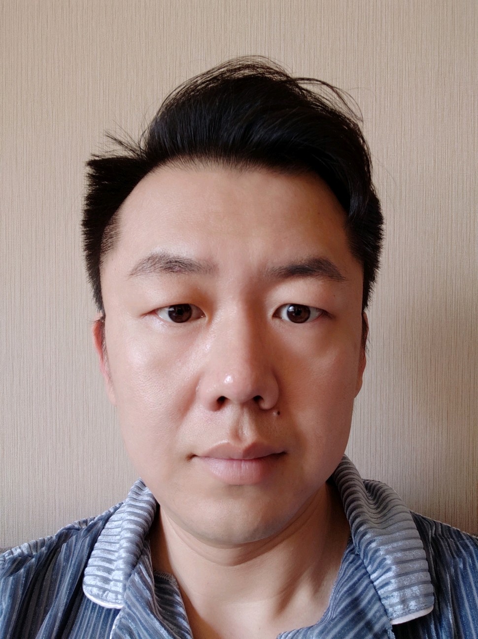 天生青蛙眼肿眼泡90作为一名男主持人也开始注重自己的_圈子-新氧