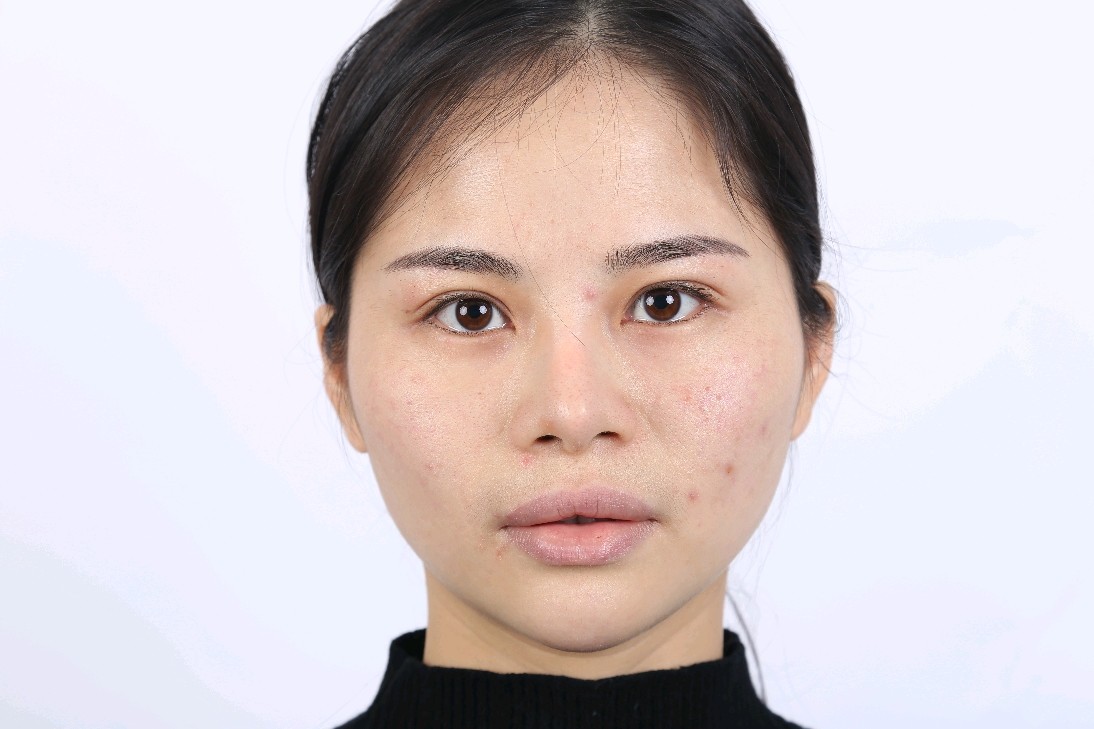 在高中时候就一直想把面部的宽颧骨改善了,由于当初要_圈子-新氧美容