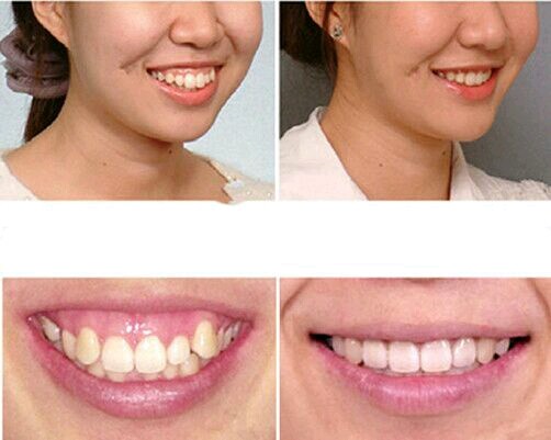 【深圳欧亚美医疗美容】#肉毒素#针对4类露龈笑的注_圈子-新氧美容整