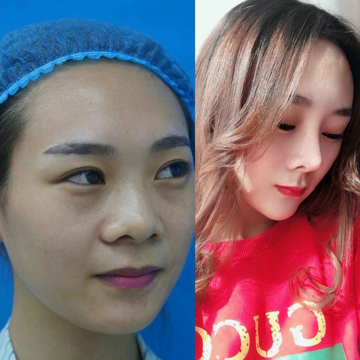 原来的鼻子打过玻尿酸,后面变宽了只吸收了部分,自己_圈子-新氧美容