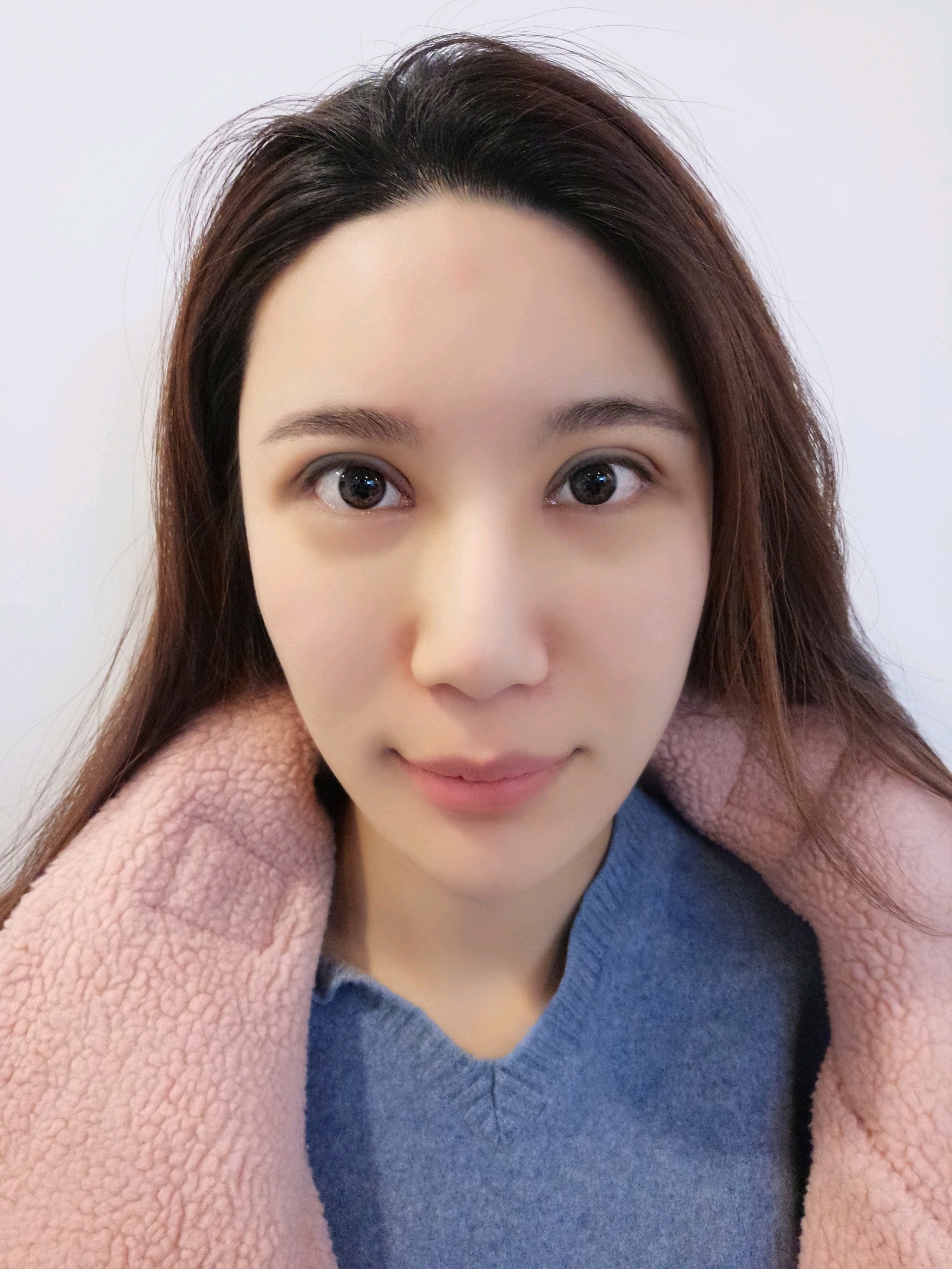 滕彦医生【眼部四项】双眼皮 内眼角 外眼角 下至术 芭比灵动大眼