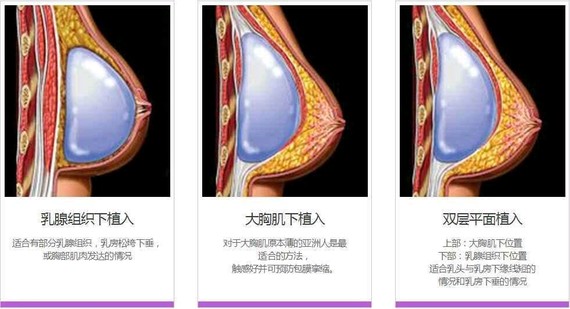 【假體隆胸後胸部下垂嗎】體豐胸分為幾種層次,假體置入胸大肌下和