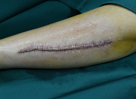 我是手术疤痕,当时外科缝合针较粗,留下了明显的疤痕_圈子-新氧美容