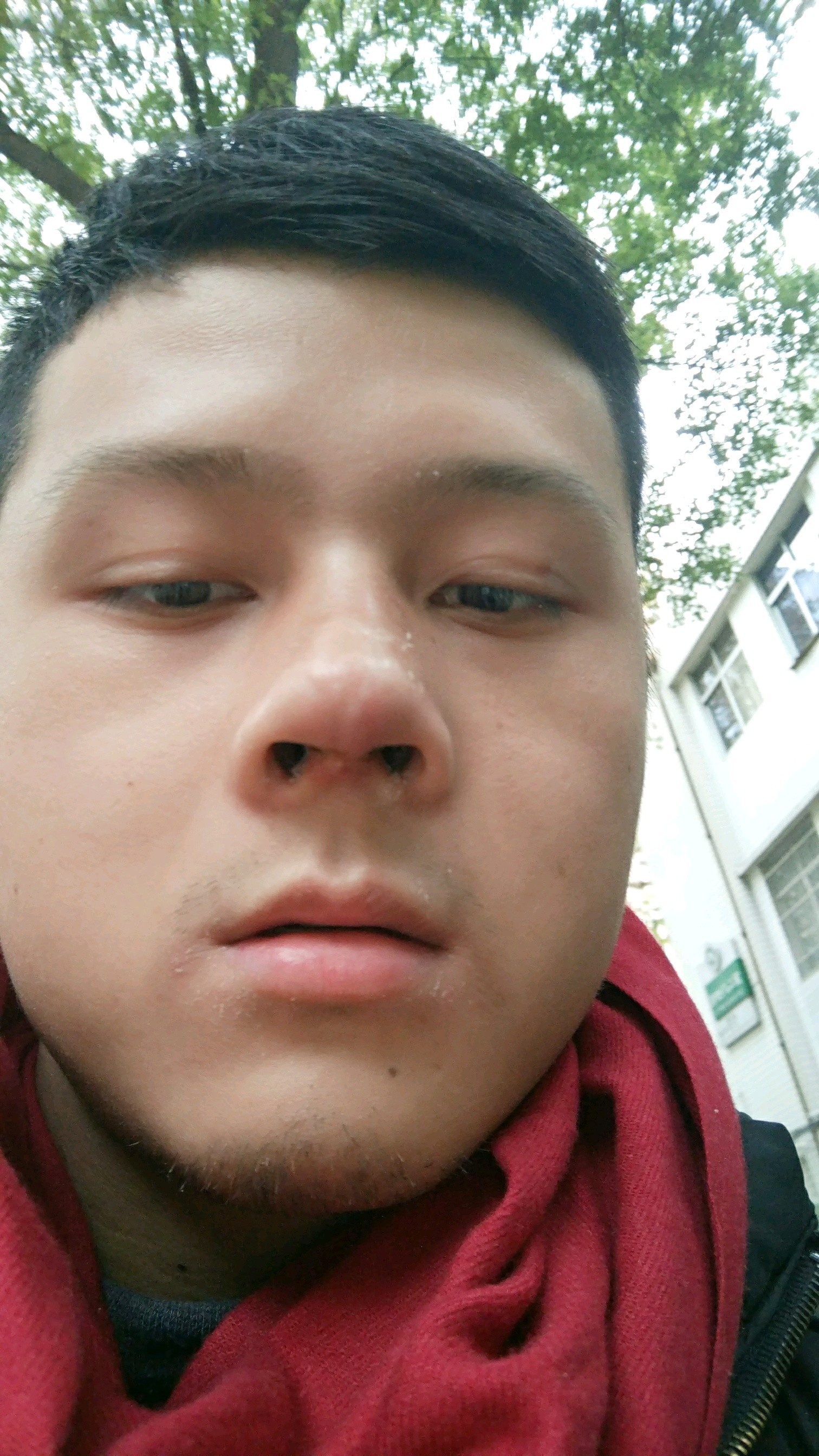 鼻子缝针疤痕图鼻子缝针鼻梁磕碰缝针鼻梁缝针留疤图片鼻子缝针留疤