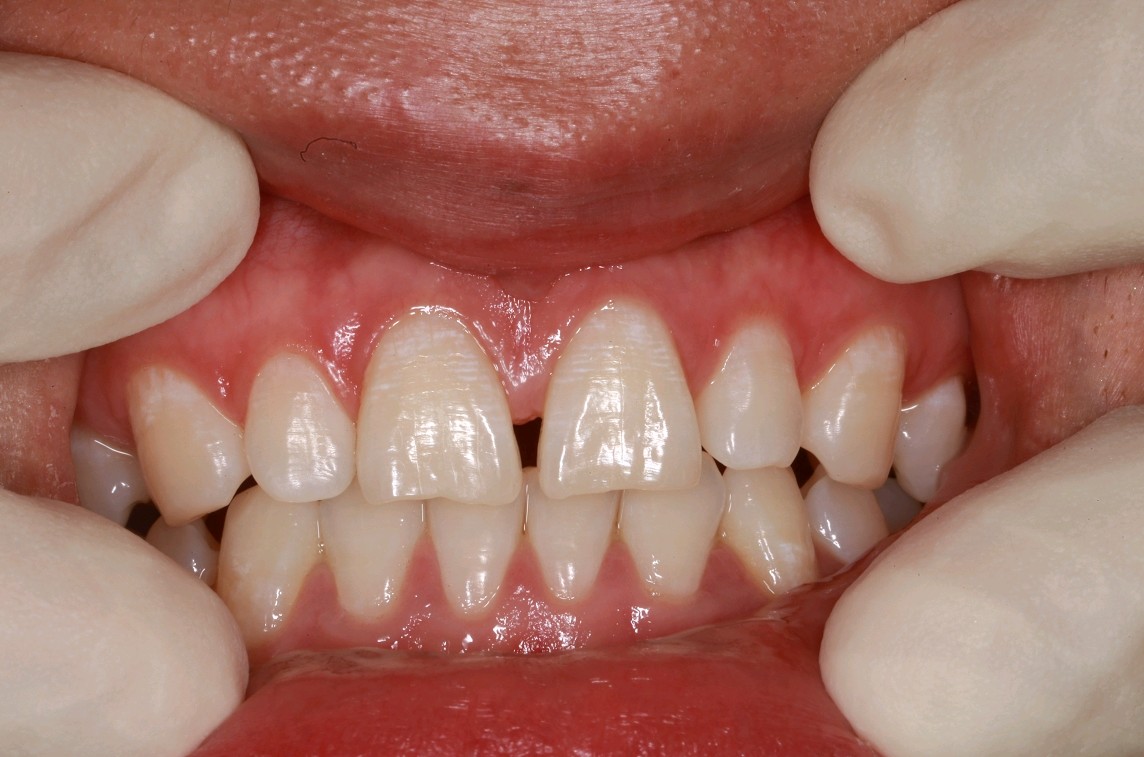 大门牙中间有道缝,我老婆就一定要我去做个美化,本来_圈子-新氧美容