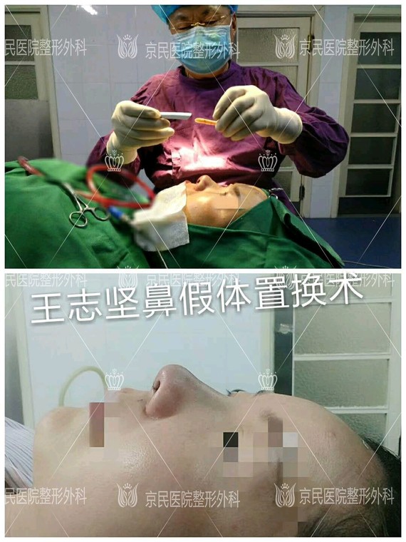 这位求美者对于之前做的鼻子形态上不满意,想要换一种_圈子-新氧美容