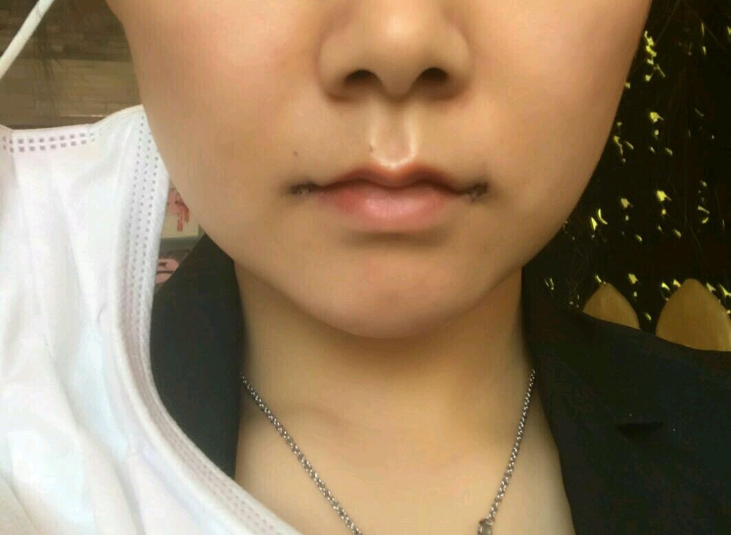 口角下垂,笑起来不好看,就想做个微笑唇改善下,没有_圈子-新氧美容