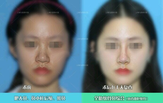 【这才是"琼鼻樱唇"的正确打开方式小肥鼻秒变秀气鼻!