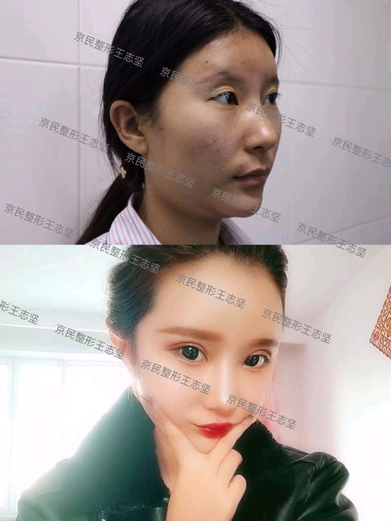 很多人都喜欢幼龄脸,上宽下窄,往往会选择丰下巴