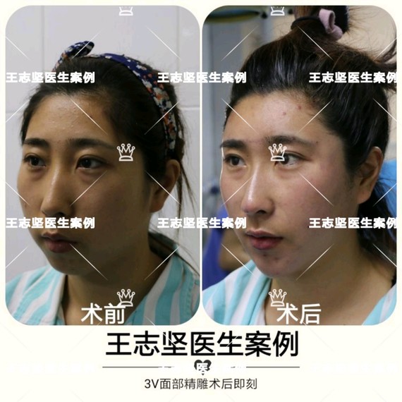 脂肪填充是一个很不错的建议,可以填充下巴,和鼻子这样也能够一举三得