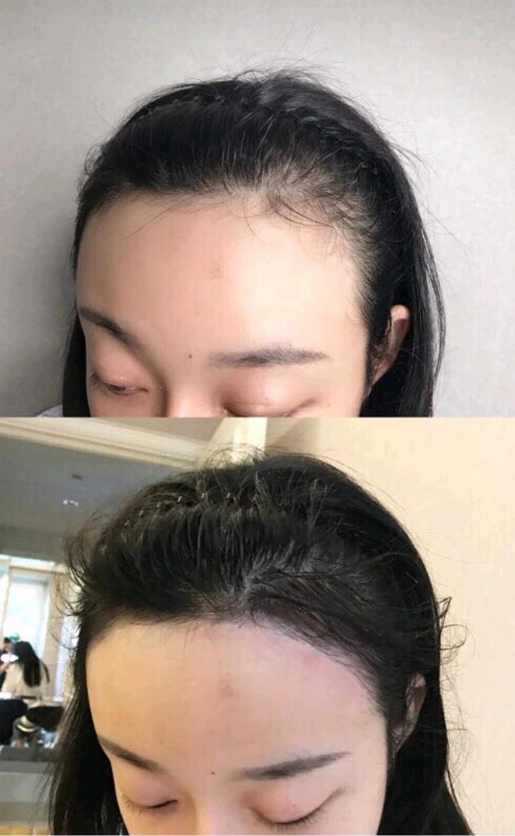我的发际线很靠后01,想做半永久发际线已经很久了,但_圈子-新氧美容
