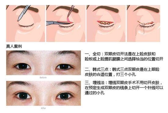 双眼皮手术是个简单易操作的手术,只要你选择一个正规_圈子-新氧美容