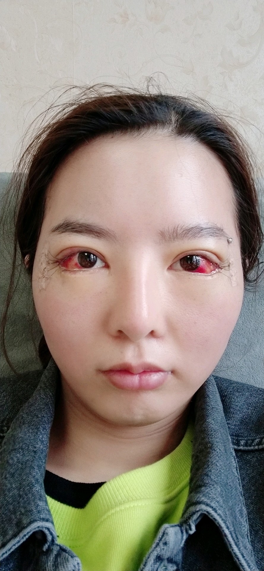 第一天做了眼睛的时候眼睛冲血特别红,特别吓人但是眼_圈子-新氧美容