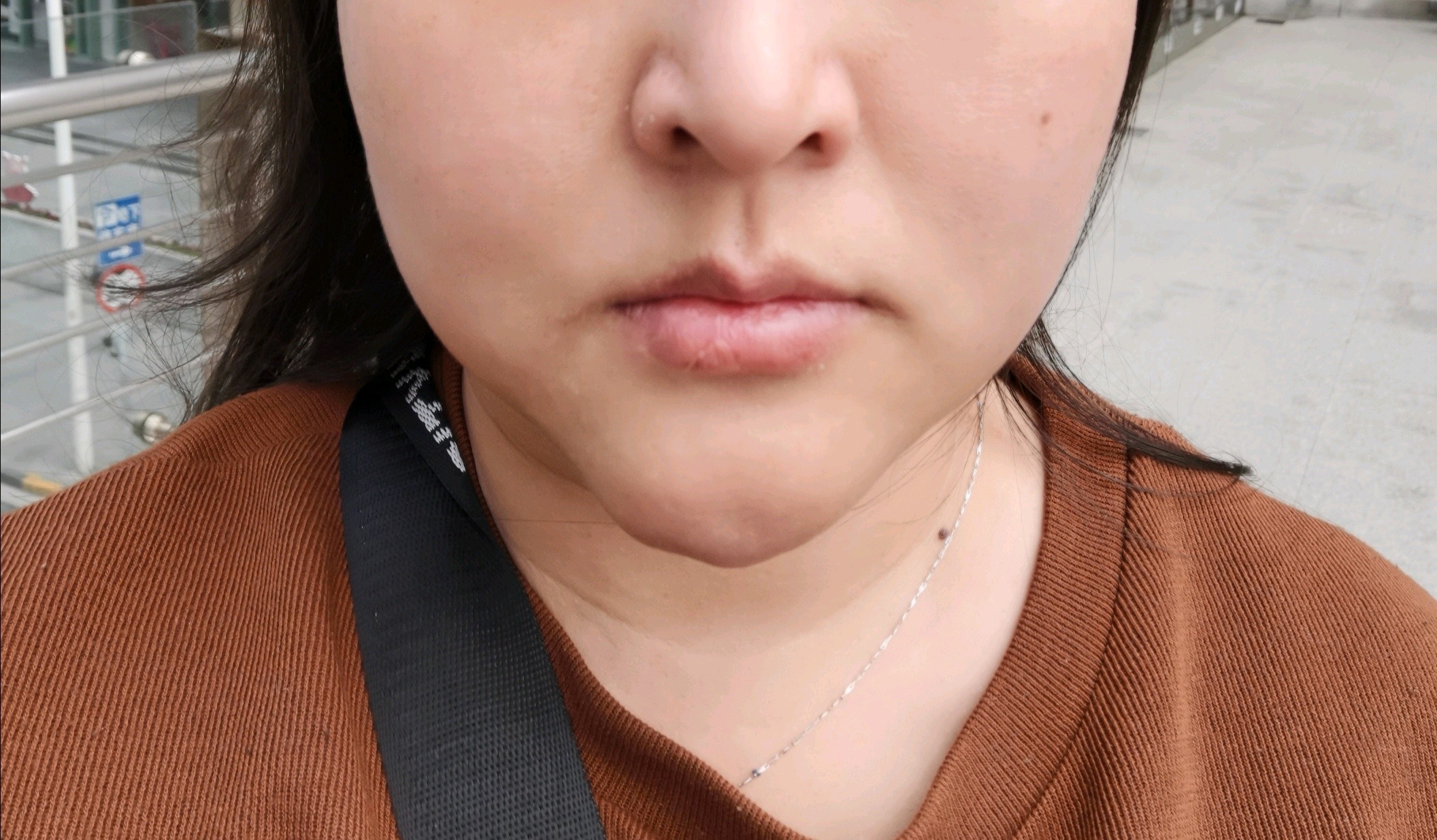 我是下巴疤痕增生有十二年了,有做医美的朋友建议我打_圈子-新氧美容