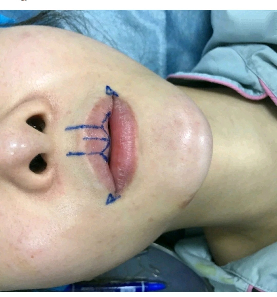 这次手术非常成功没想到我的唇形那么精致好看