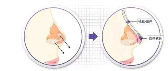 #L型假体和柳叶形假体的区别#两种假体主要的