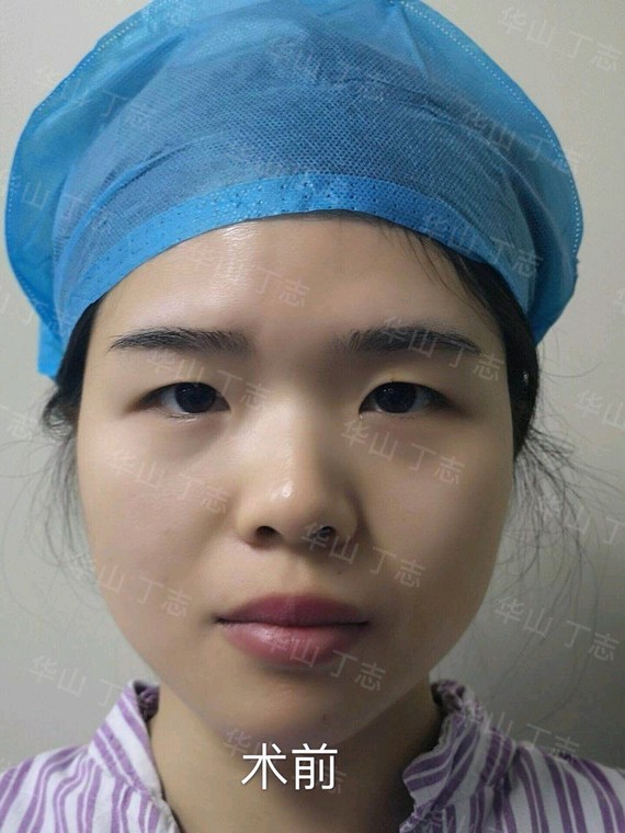 女,28岁,予全切双眼皮 内眦赘皮矫正术,手术照片_圈子-新氧美容整形