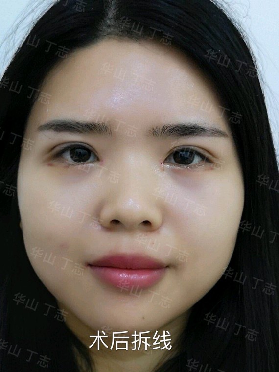 女,28岁,予全切双眼皮 内眦赘皮矫正术,手术照片_圈子-新氧美容整形