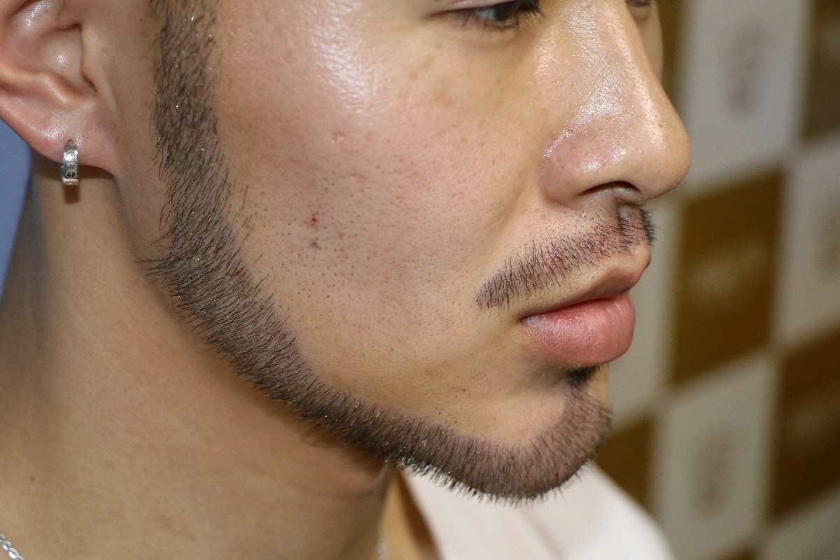 【种植胡须】【首瑞植发胡须种植 大额满减买送】华西青年名医 国家