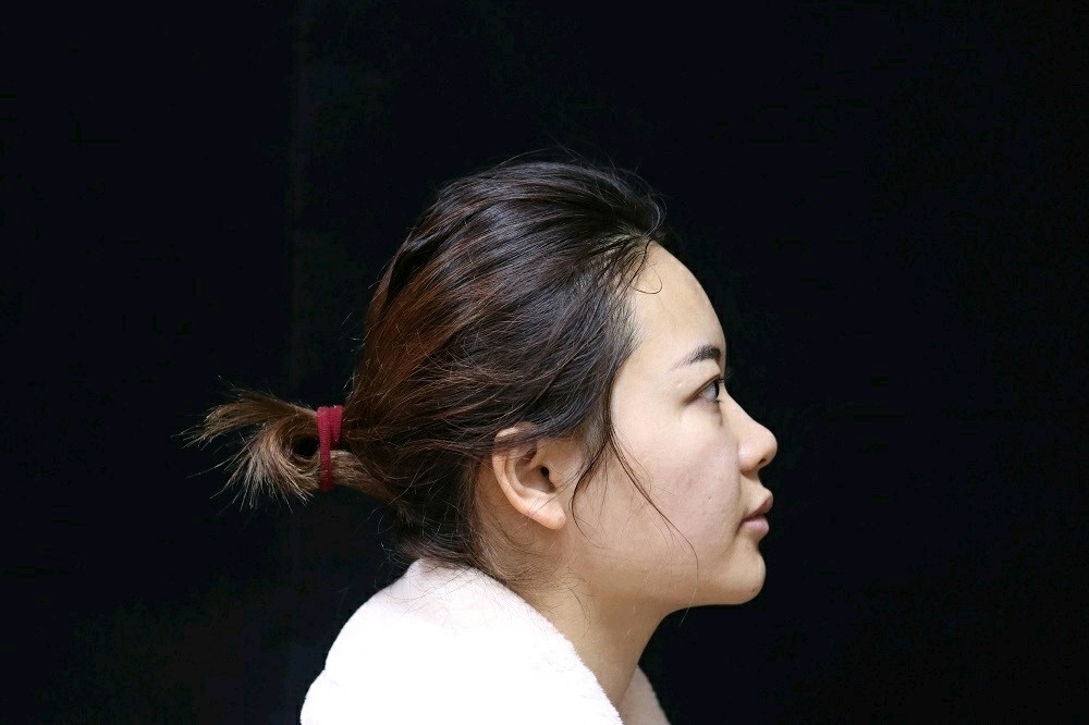 硅胶隆鼻鼻部整形改善山根低矮凹陷塌鼻低鼻