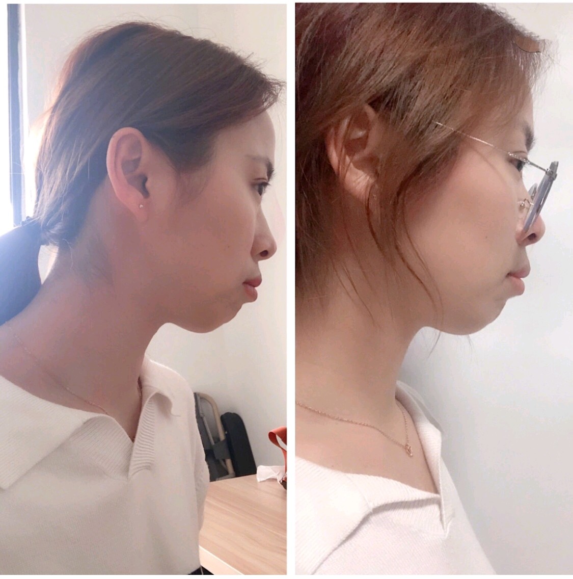 深覆合上牙比较突下牙也不整齐下巴后缩是因为咬合不正容易睡觉时张着