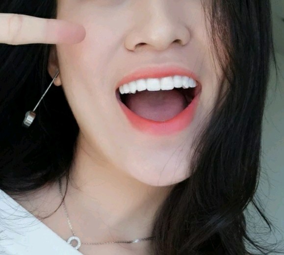 我是那种牙齿不白的女生,一直都非常的羡慕牙齿白的女_圈子-新氧美容