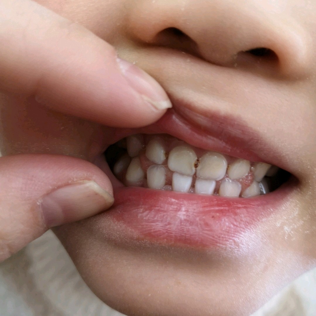 儿童蛀牙严重图片