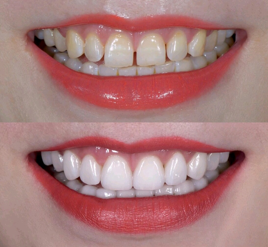 很好的瓷贴面,不仅解决了牙缝大的问题,还解决了牙黄_圈子-新氧美容