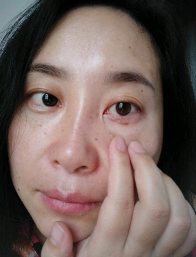 买了一支玻尿酸填了下泪沟,刚打完会有一点淤青,三四_圈子-新氧美容