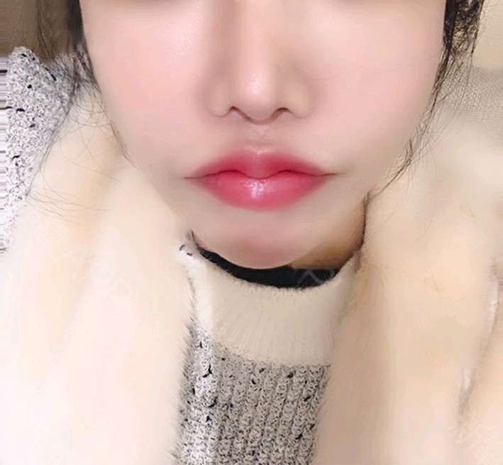 【厚唇改薄】嘴角上提/微笑唇/嘟嘟唇/m唇/人中缩短@原上海九院王文革