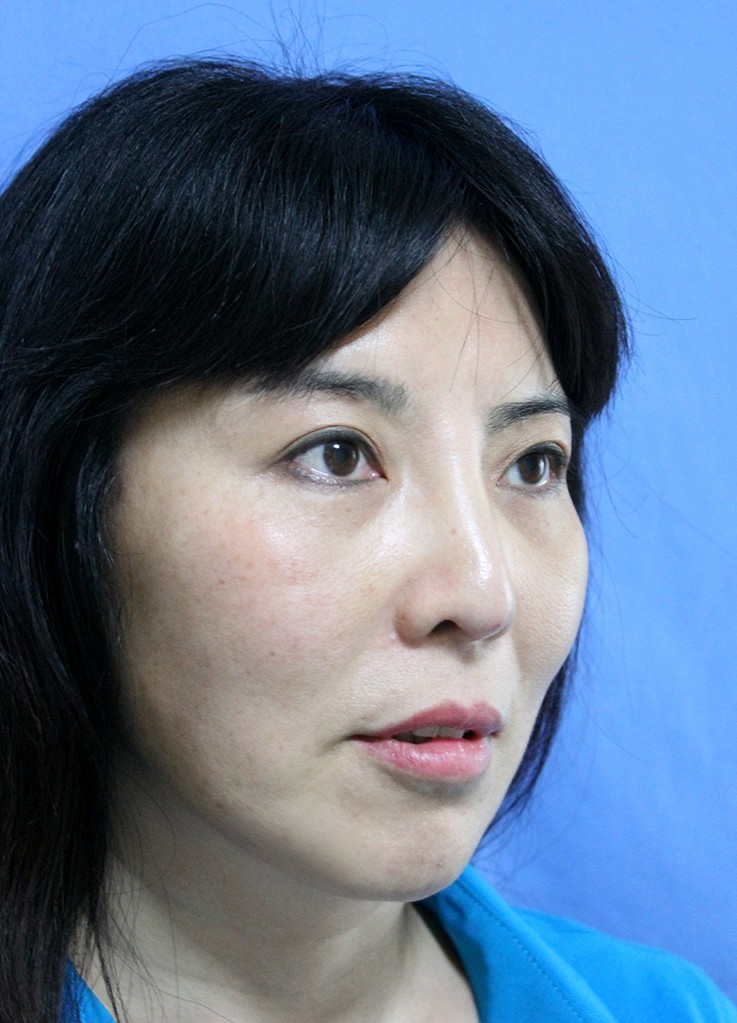 【拉皮手术提升】额头/上面部/中下面部/全面部提拉,彻底改善面部皱纹