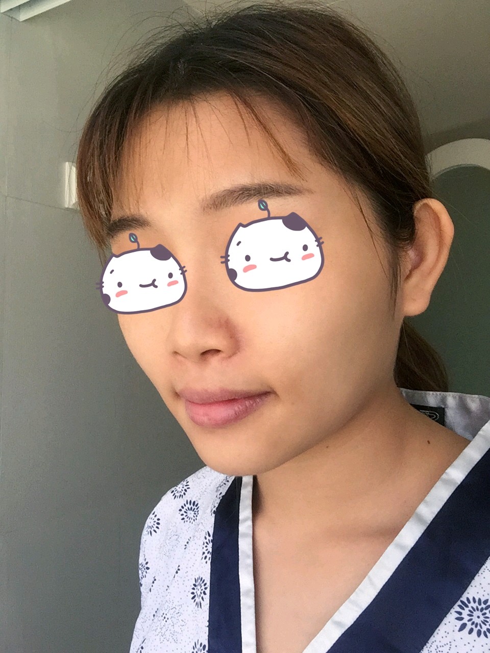 botox瘦脸 下颌缘提升20天.