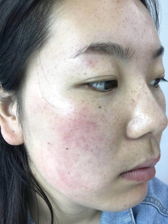 我脸上的斑从小就有了,我感觉很自卑,都不敢近距离跟_圈子-新氧美容