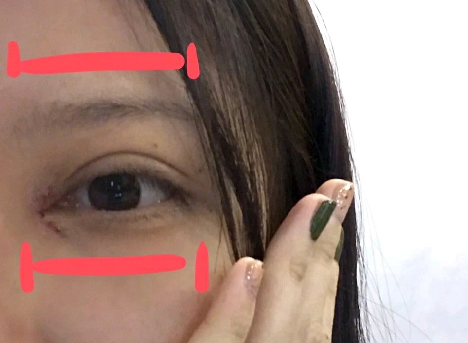 【开内眼角】【隐形开眼角】①一字切开法②院长亲自操作③恢复时间短