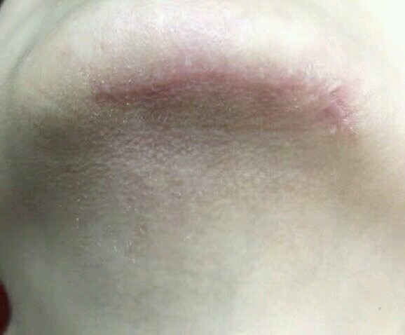 下巴的疤是大学时候摔跤划伤的,增生了,越来越突出来_圈子-新氧美容