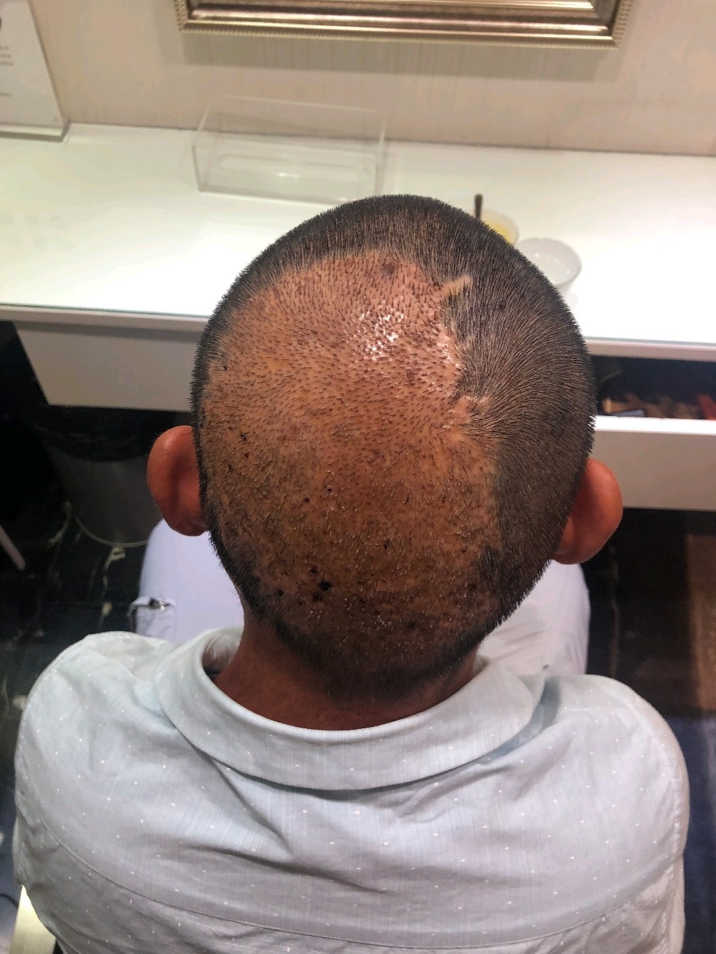 种植有12天头发有很大的疤痕是小时候烧伤是朱医生给