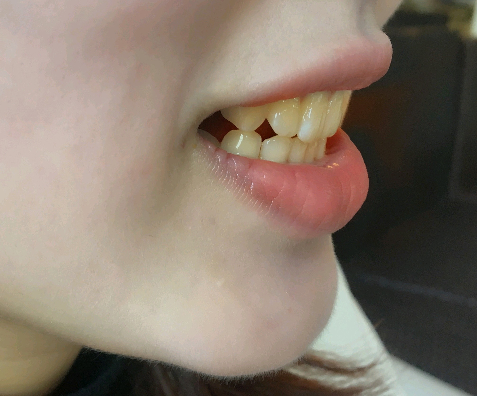 本身牙齿是过小牙,因此和下牙咬合的时候会有一个缝隙