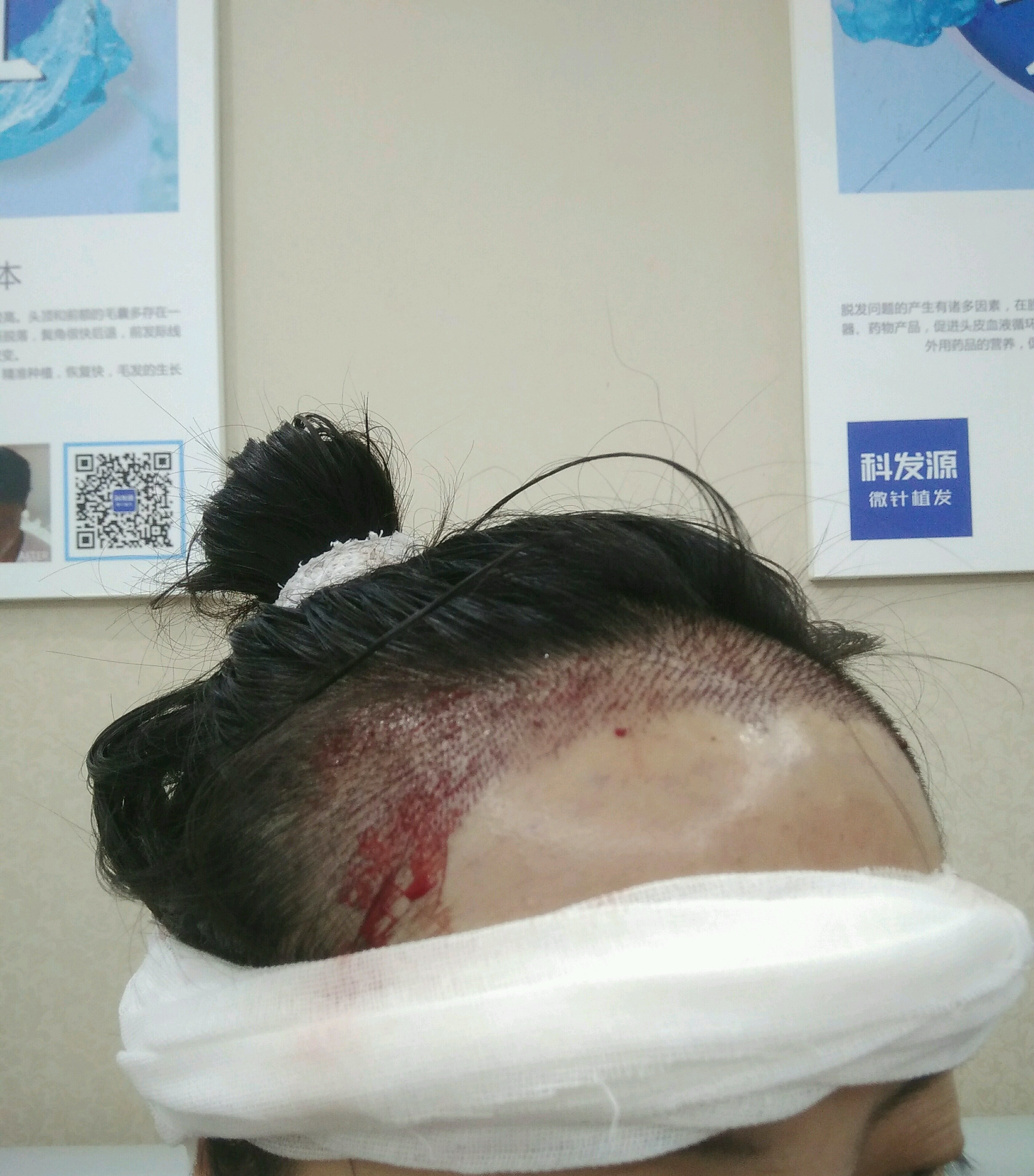 手术是注射式局部麻醉,因为我是1800个单位的植发_圈子-新氧美容整形