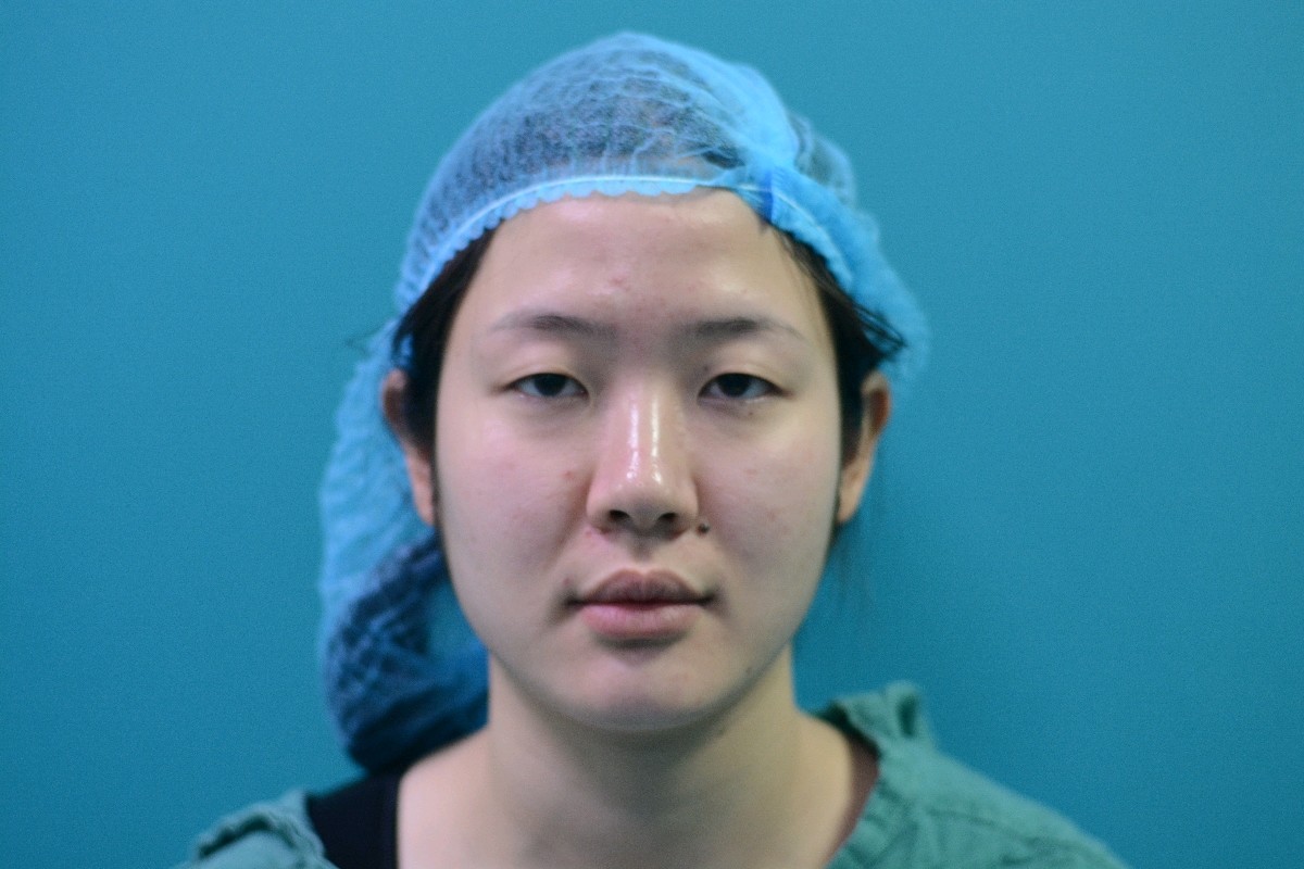 了医生,建议我做眼部多项手术,切开双眼皮然后去脂肪,提肌加上开眼角