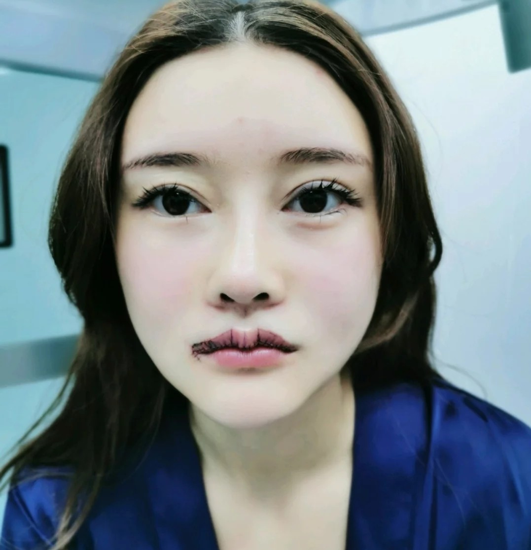 一直以来对自己唇型不太满意上唇是没有唇珠加凸的.