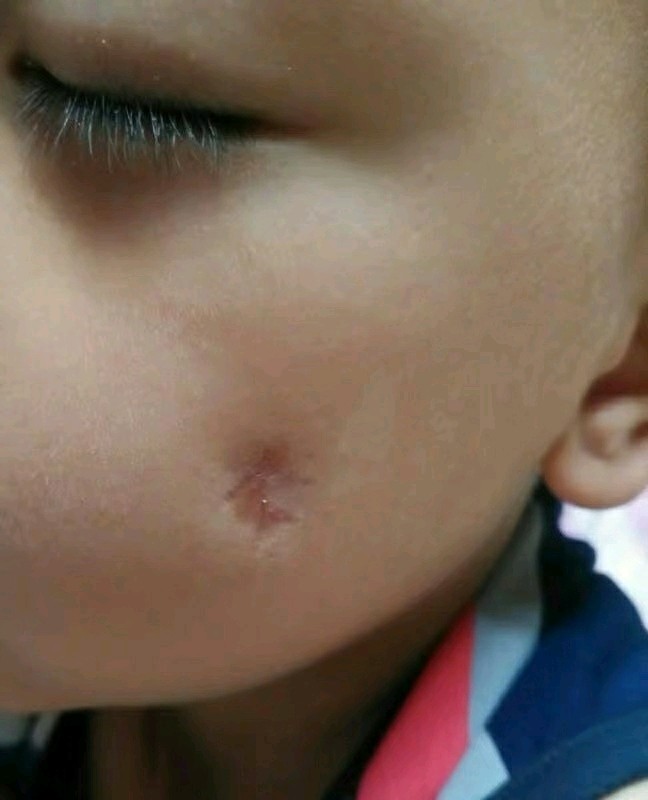 每次看着孩子脸上的疤我都特别过意不去,因为就是因