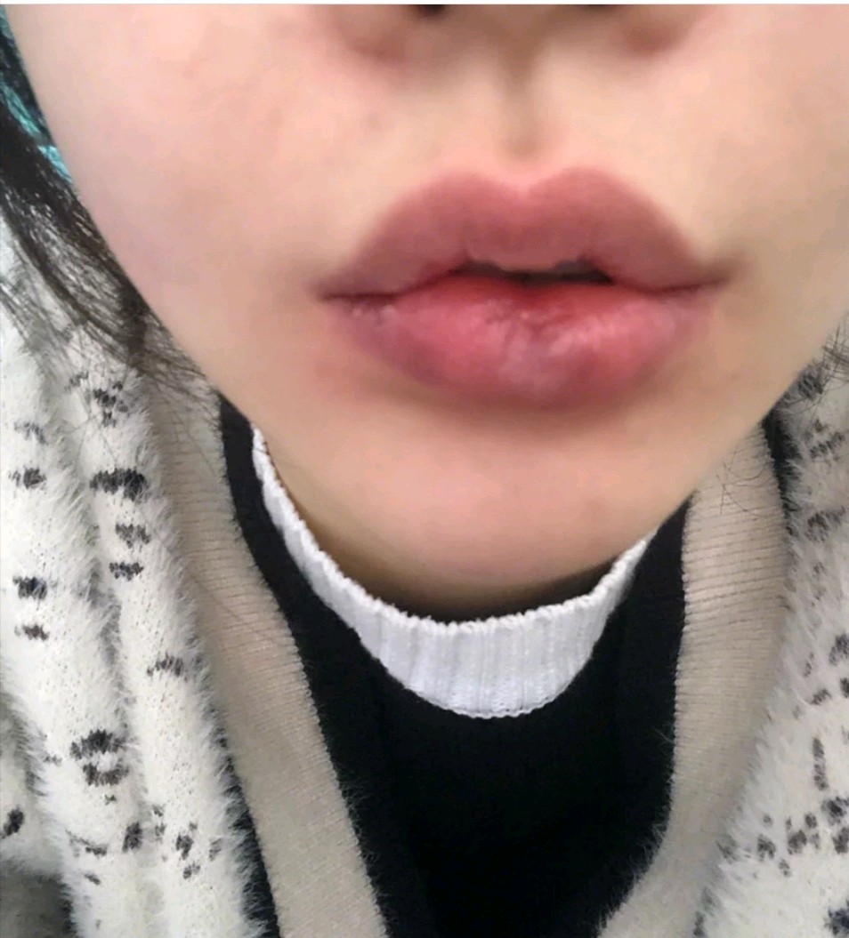 【厚唇改薄】厚唇改薄(上唇/下唇)告别嘴唇肥大/唇形外翻/香肠嘴/上下