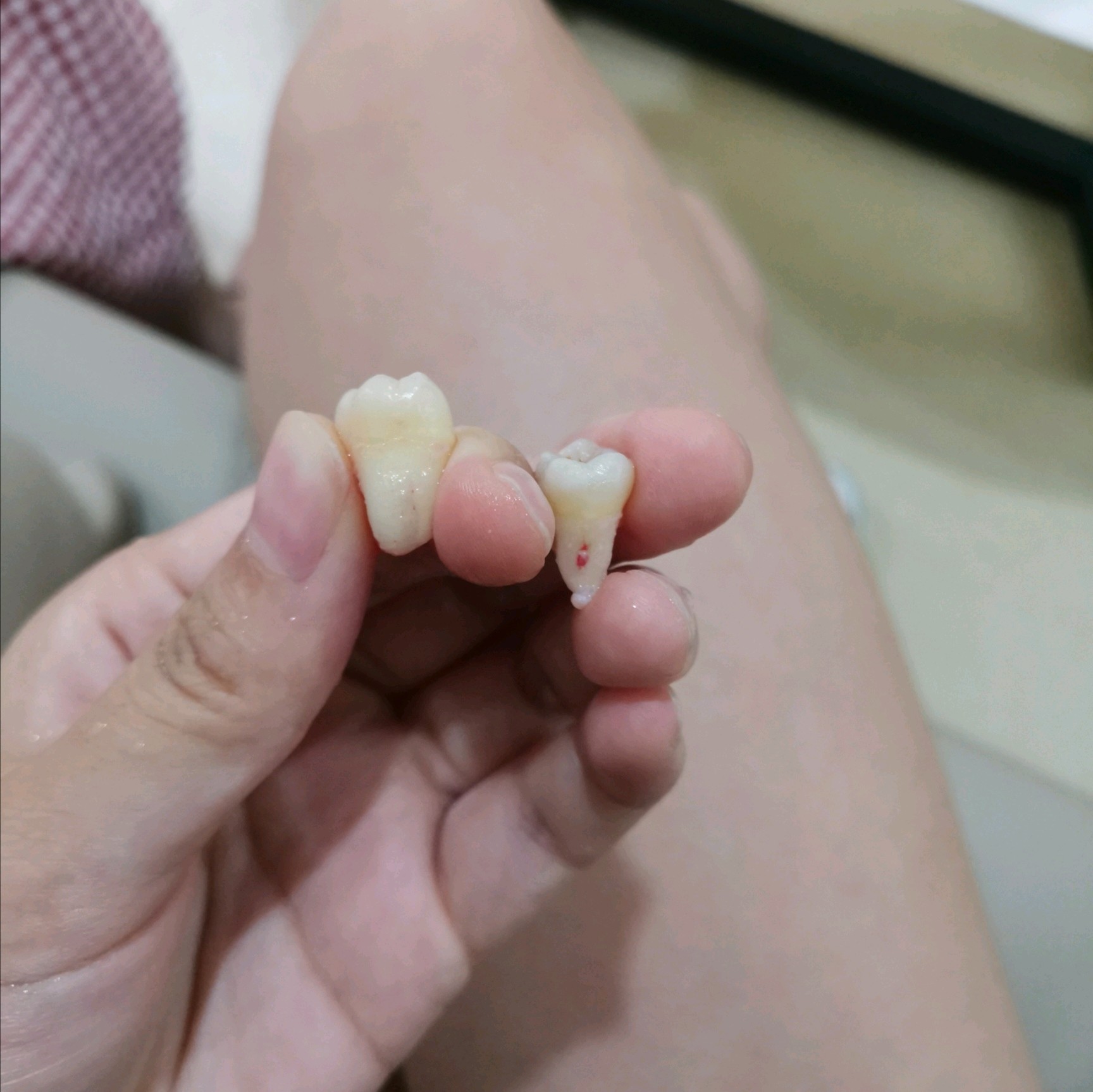 【拔智齿】牙齿拔牙 拔上颌智齿(正位) 尽早拔除 减少疼痛发炎 物质