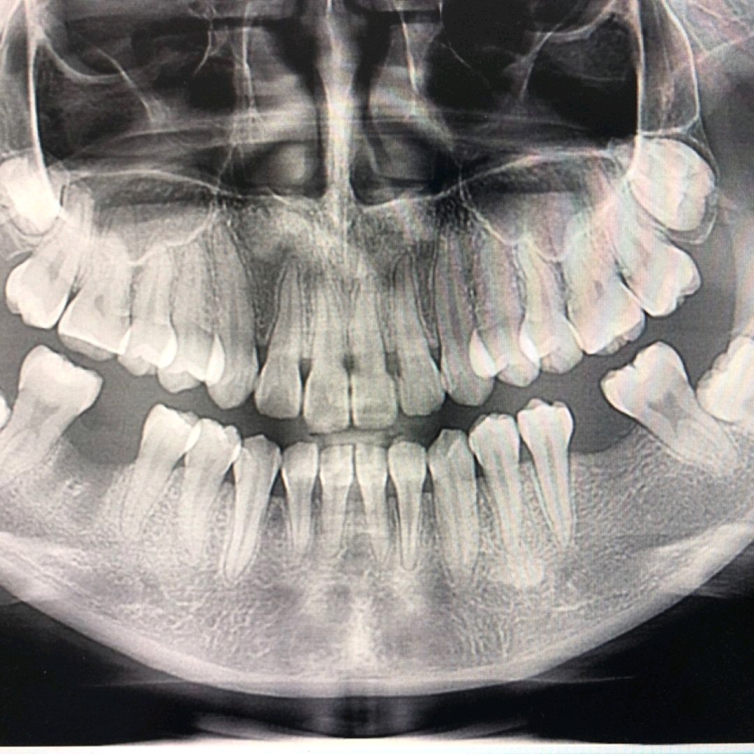 种植牙真的不是老年人的专利~我来种牙了~一颗大牙