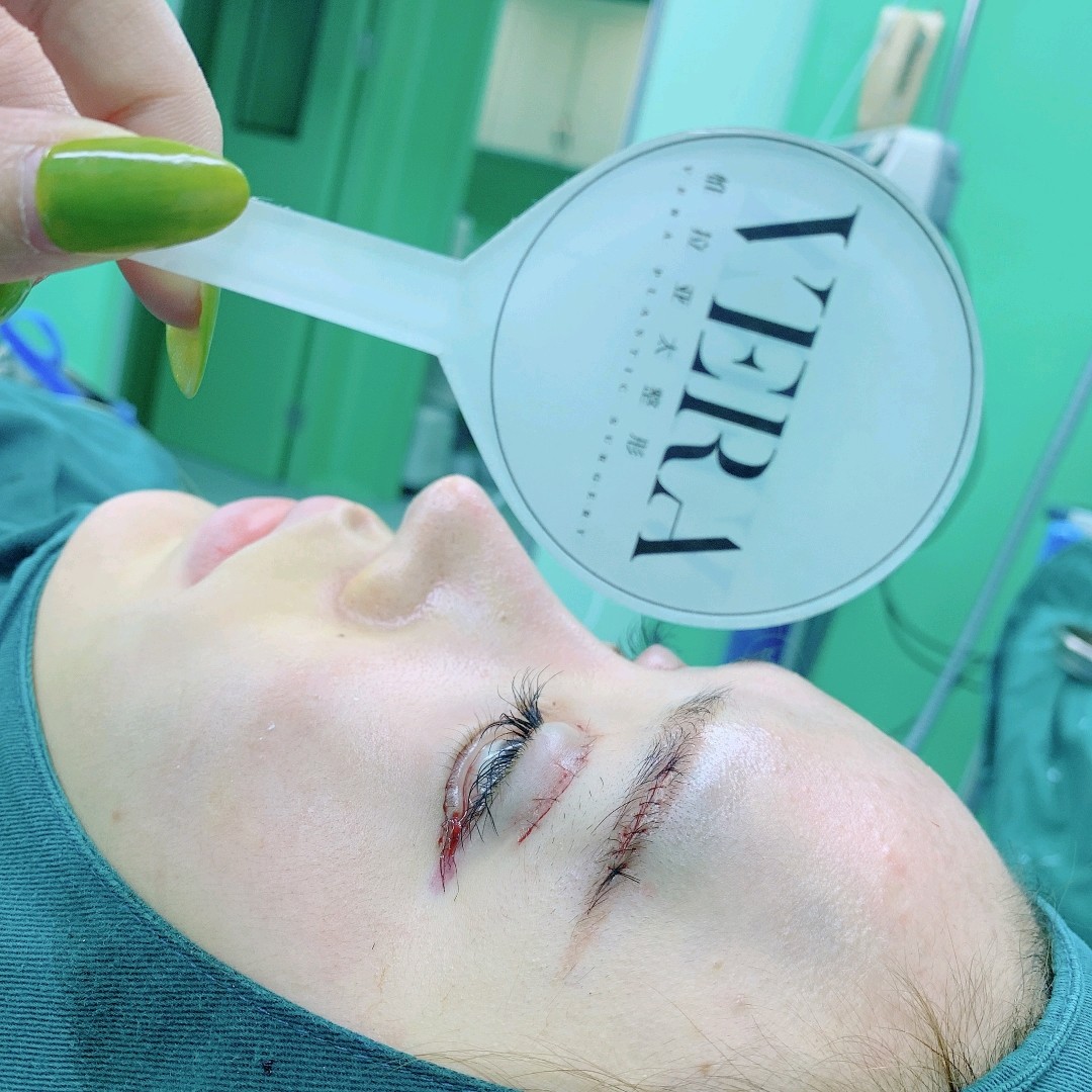 假体垫眉弓韩士生科面假体混血立体感硅胶垫眉弓隆眉弓假体眉心进口