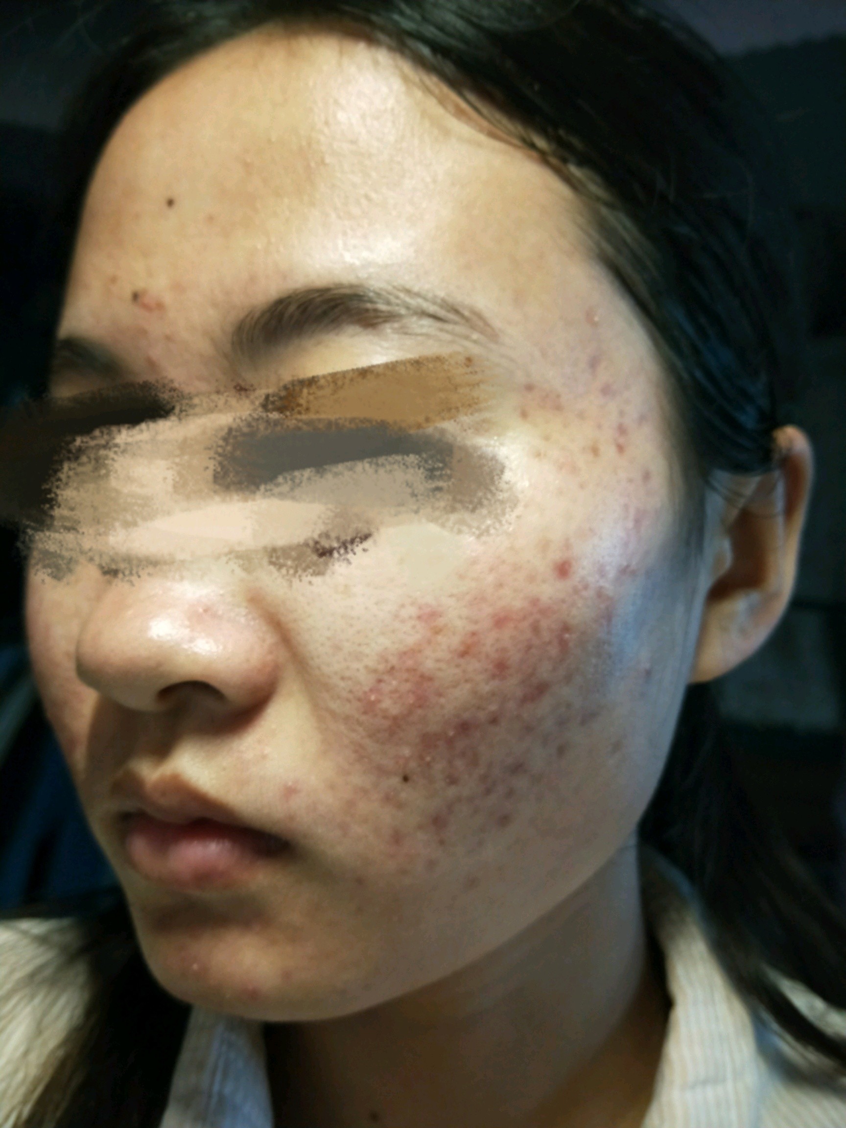 (前两张刷酸前,后两张是一疗程之后)真心建议,烂脸一定要早治疗!