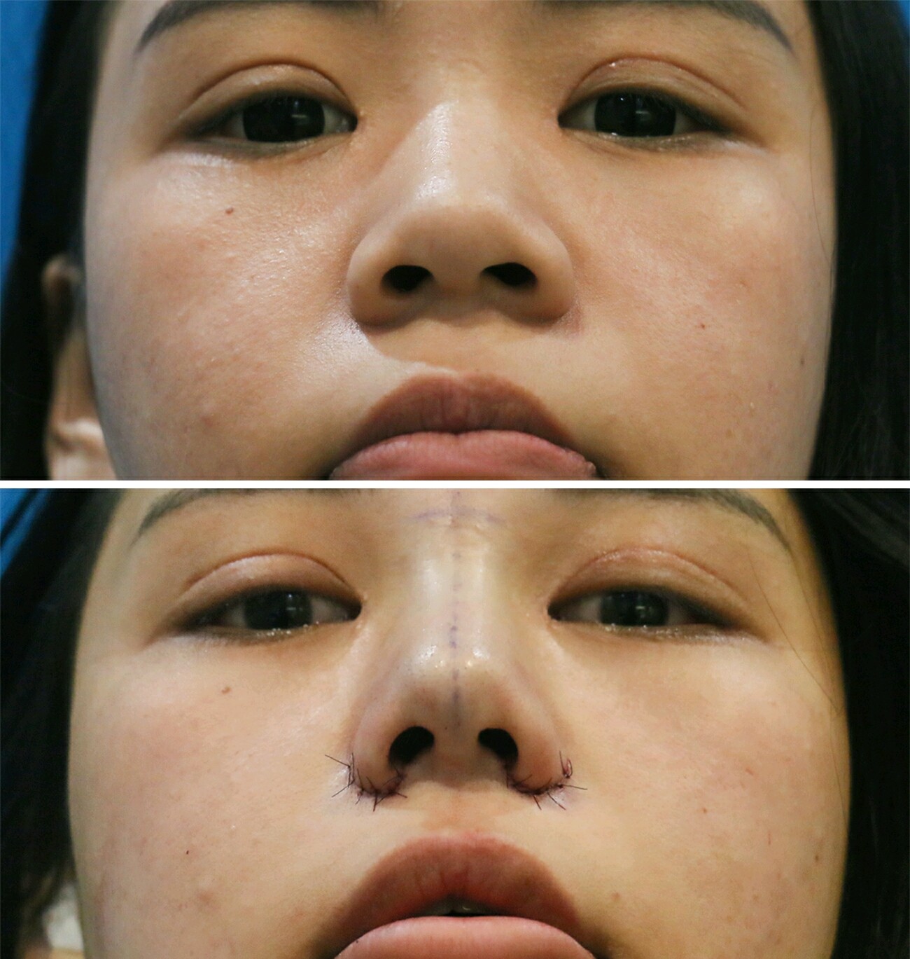 【超a鼻】【假体垫鼻基底】立秀膨体上海九院医生团队【假体垫鼻基底