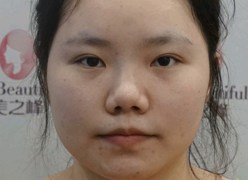 0                                  之前鼻子一点鼻梁都没有,也就是