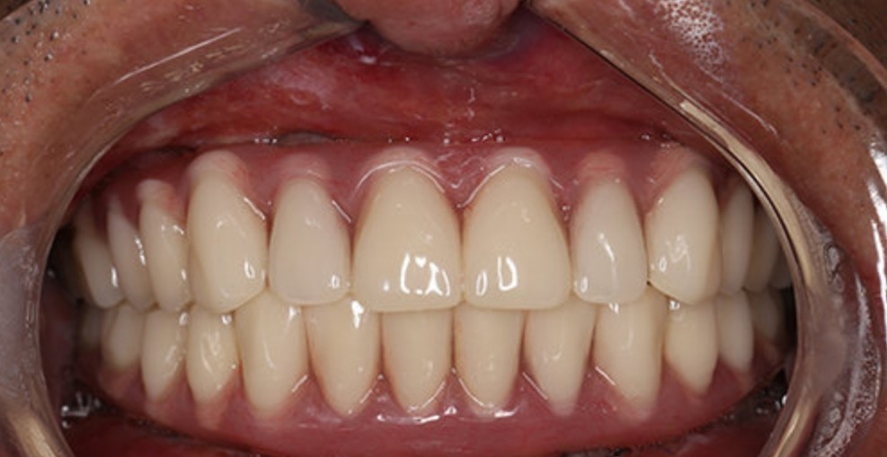 做完手术已经几个月了,牙冠是5个月左右的时候装上去_圈子-新氧美容