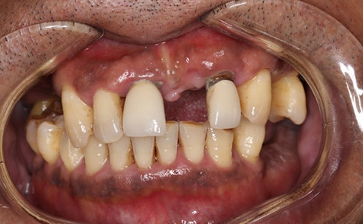 做完手术已经几个月了,牙冠是5个月左右的时候装上去_圈子-新氧美容